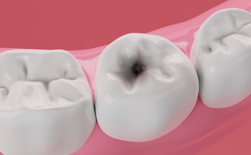 I May Need a Dental Filling, Which Dentist Can Help?