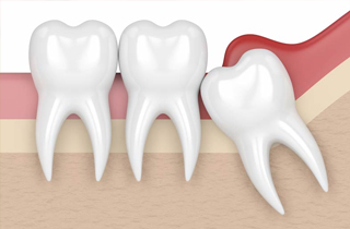 Wisdom Tooth Extraction in Oxnard, CA 93036