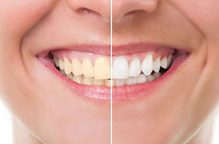 Tooth Colored Dental Fillings in Oxnard